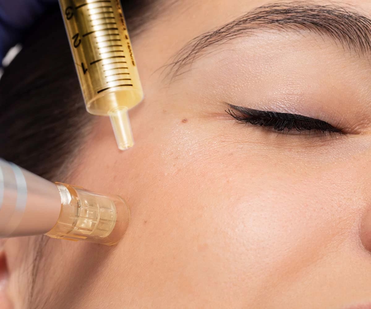 Microneedling w/ PRP main image