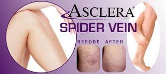 Sclerotherapy main image